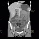 Crohn's disease of ileum, CT enterography: CT - Computed tomography